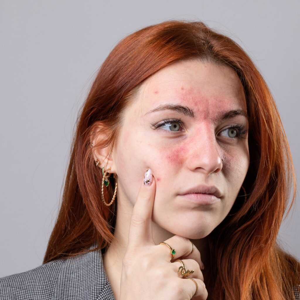 Rosacea-prone skin