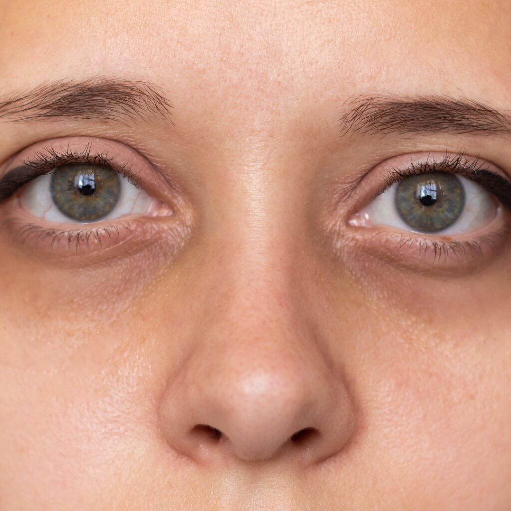 Under Eyes
