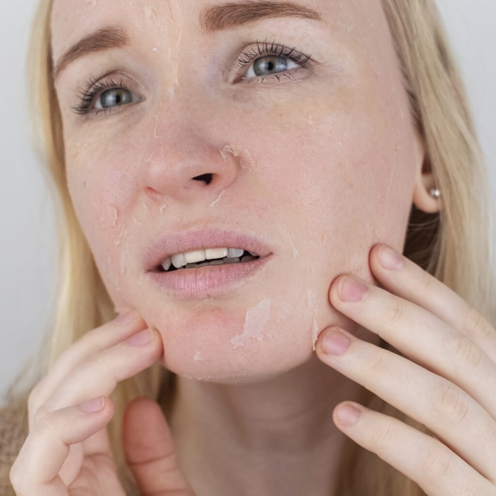 Eczema and dry patches