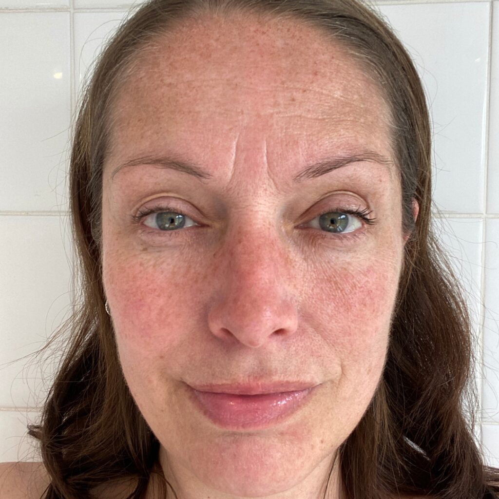 Acne-Prone Skin