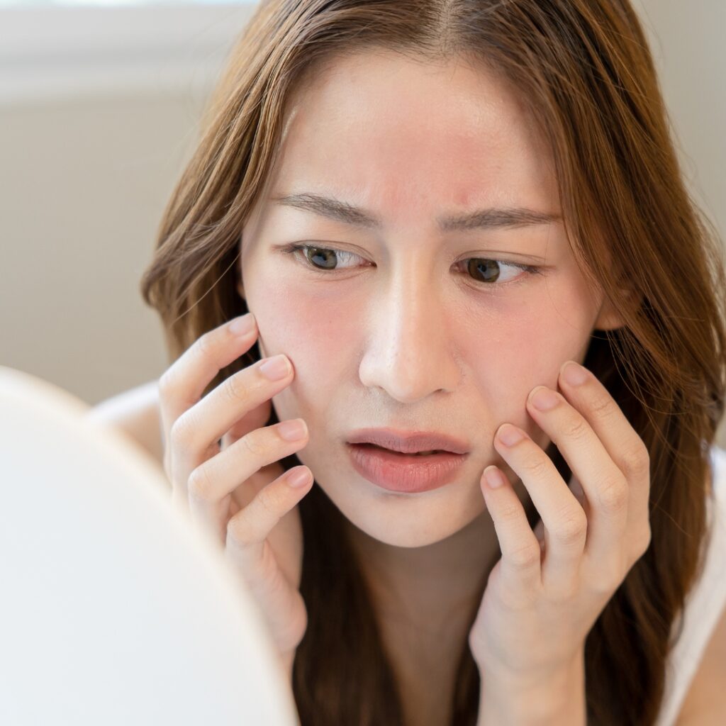 Sunburn and inflammation