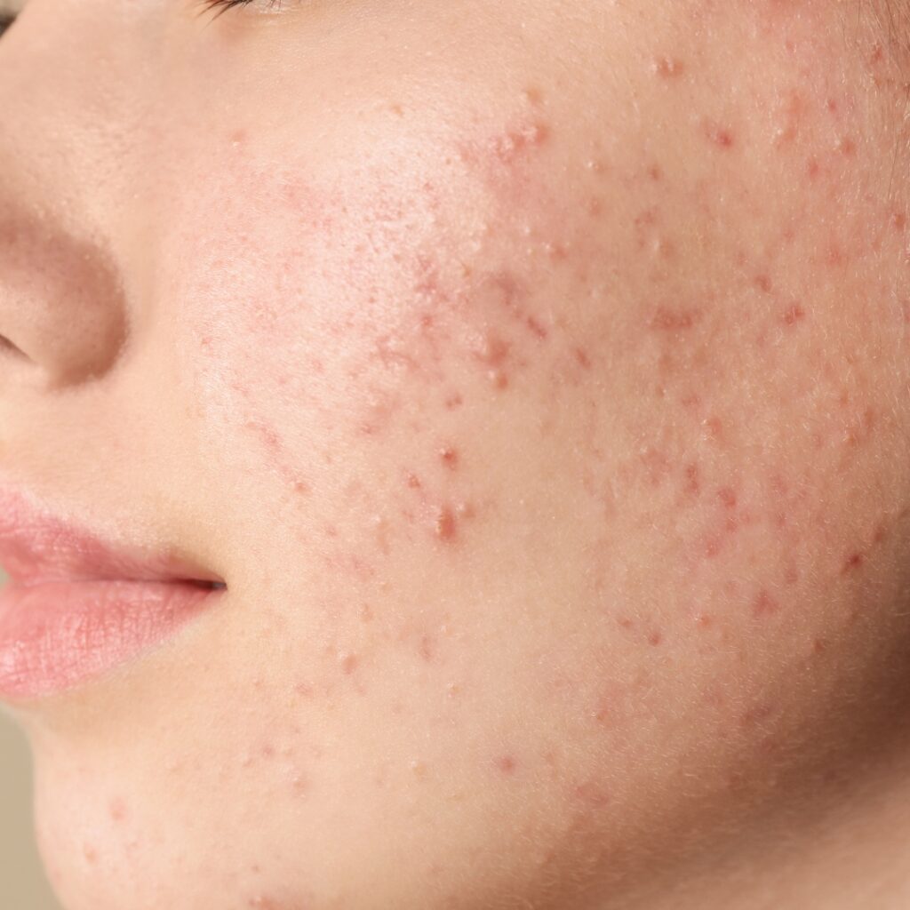 Acne marks and mild scarring
