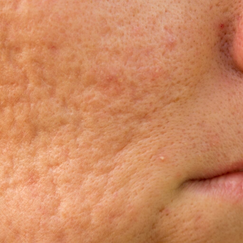 Enlarged or clogged pores