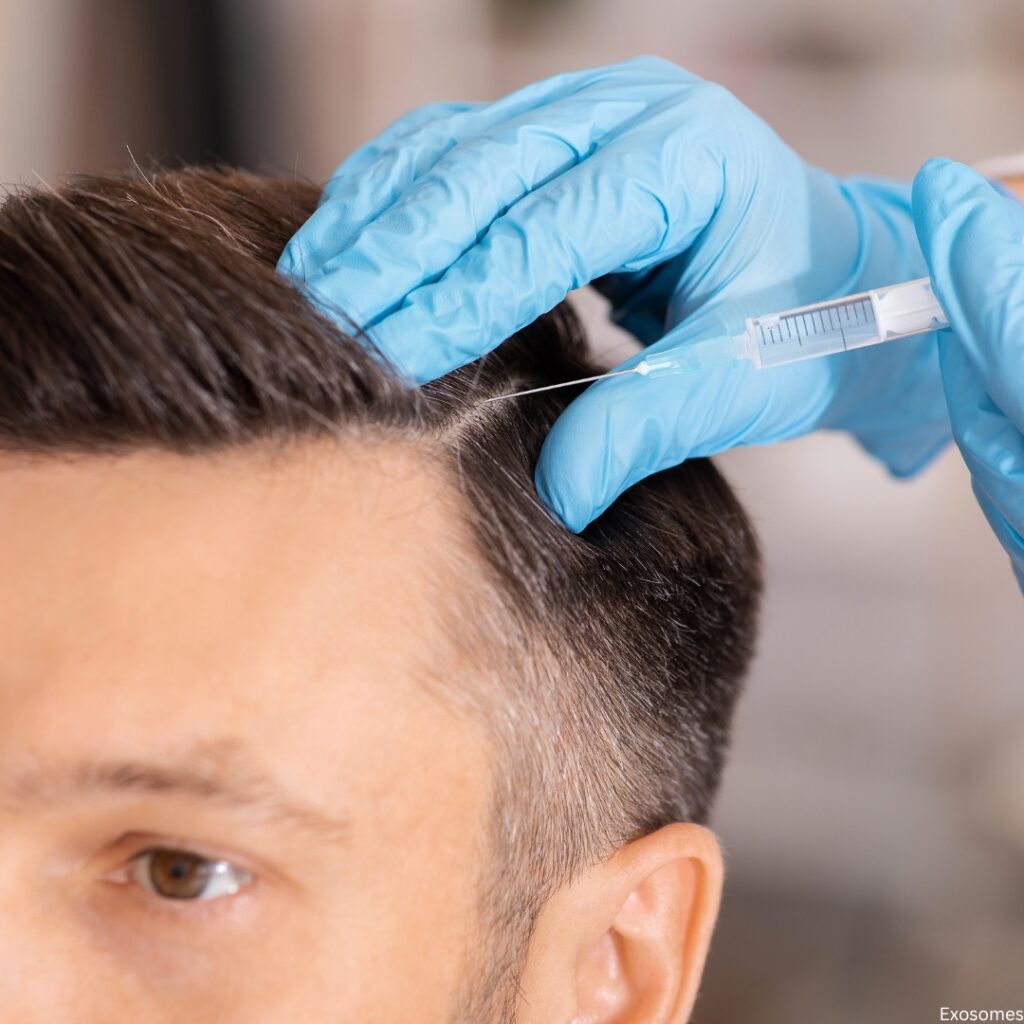 Exosomes Hair Treatments