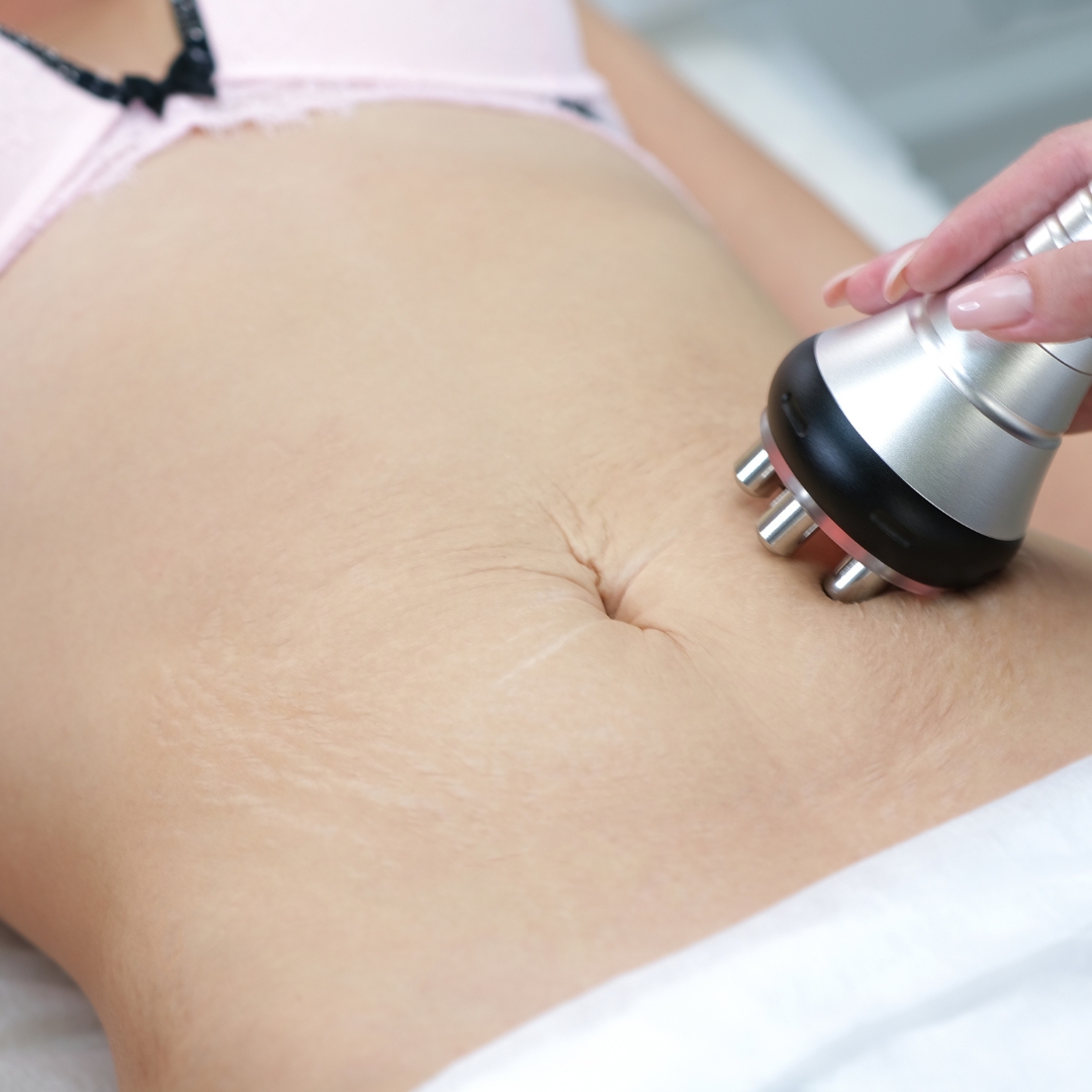 ultrasound Skin Tightening Treatment