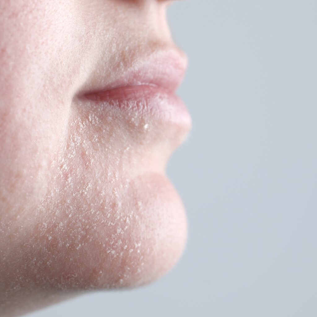 Dehydrated and rough skin