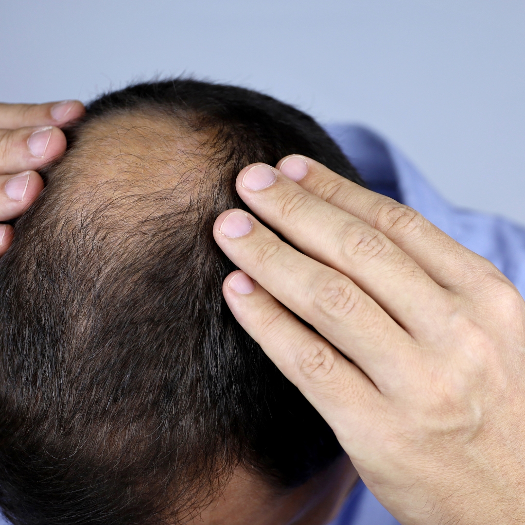 Telogen & Chronic Hair Loss