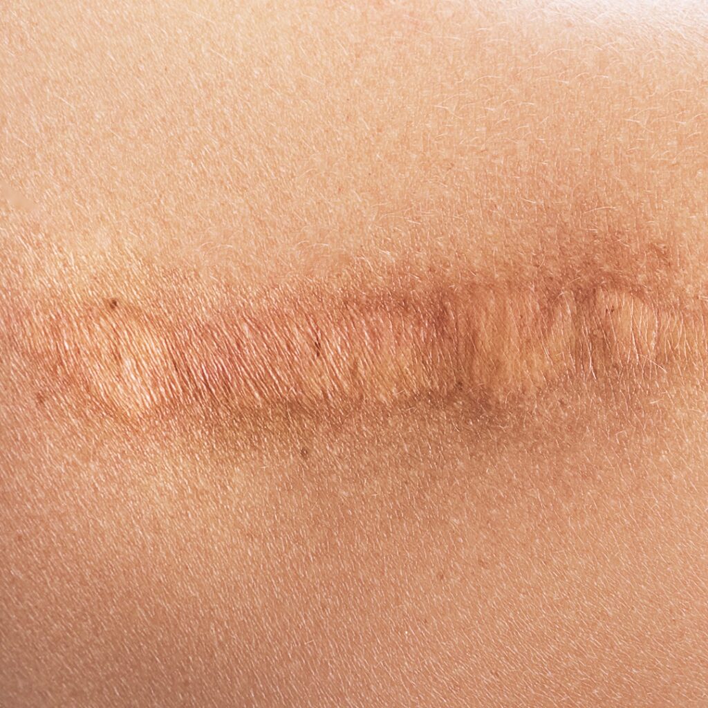 Surgical scars