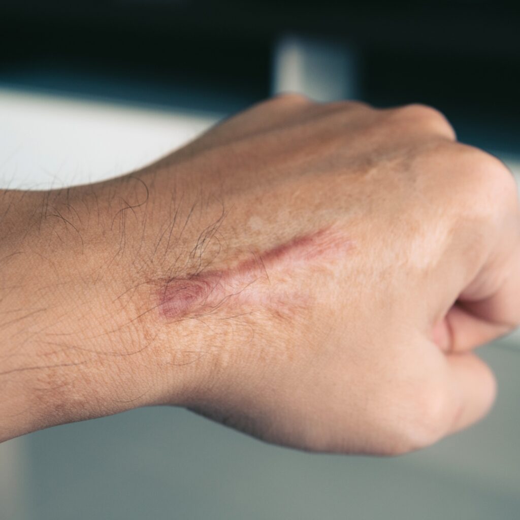 Burn scars