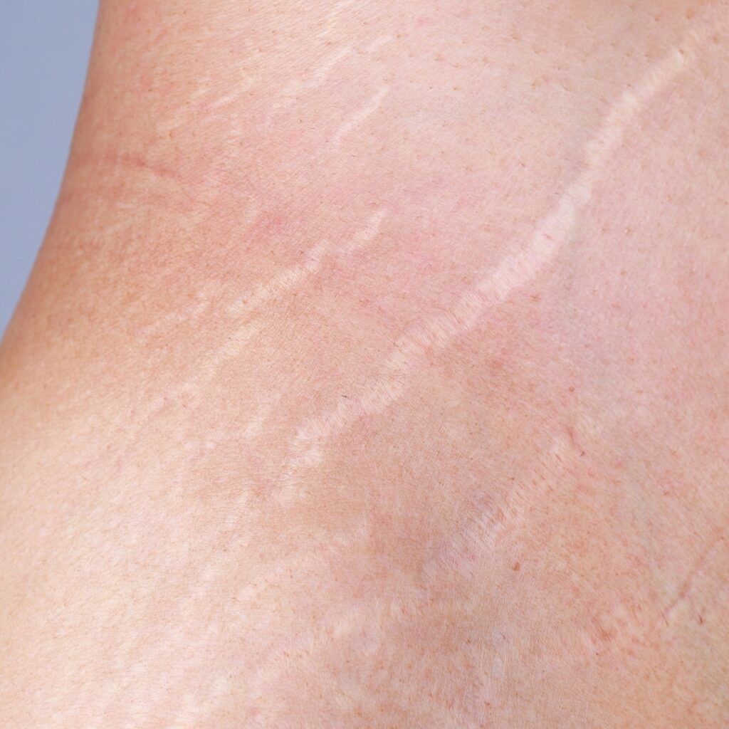 Stretch marks