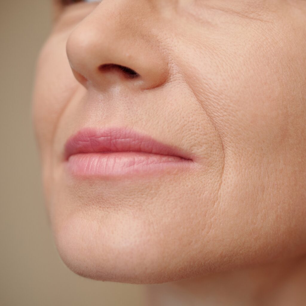 derma fillers Nasolabial Folds