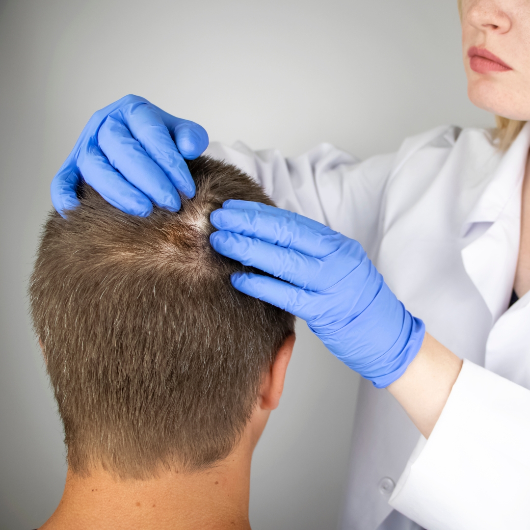 Male Hair loss Pattern