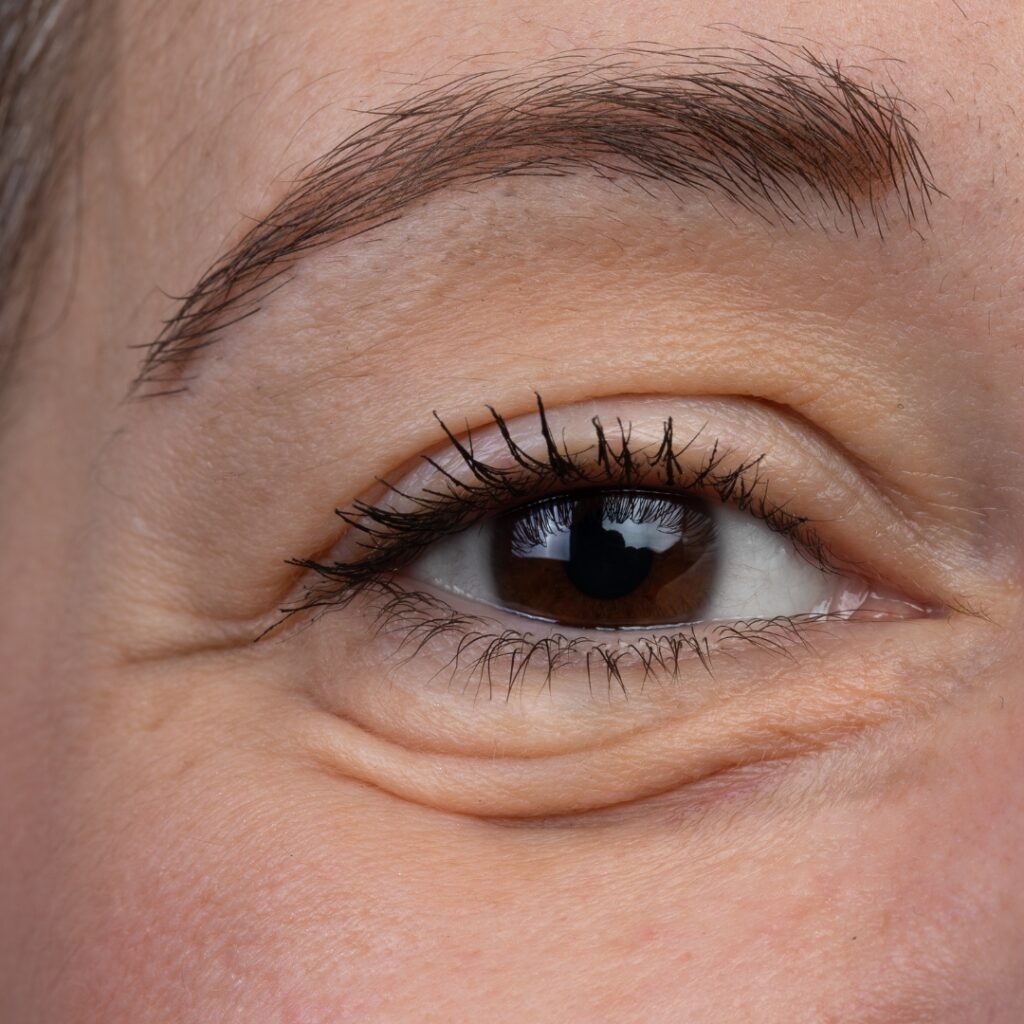 Under-Eyes derma fillers