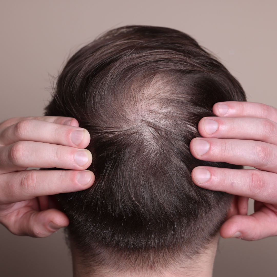 Alopecia Areata