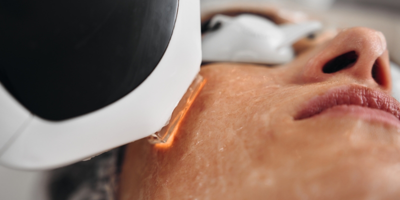 Acne & Pigmentation Treatment Facial