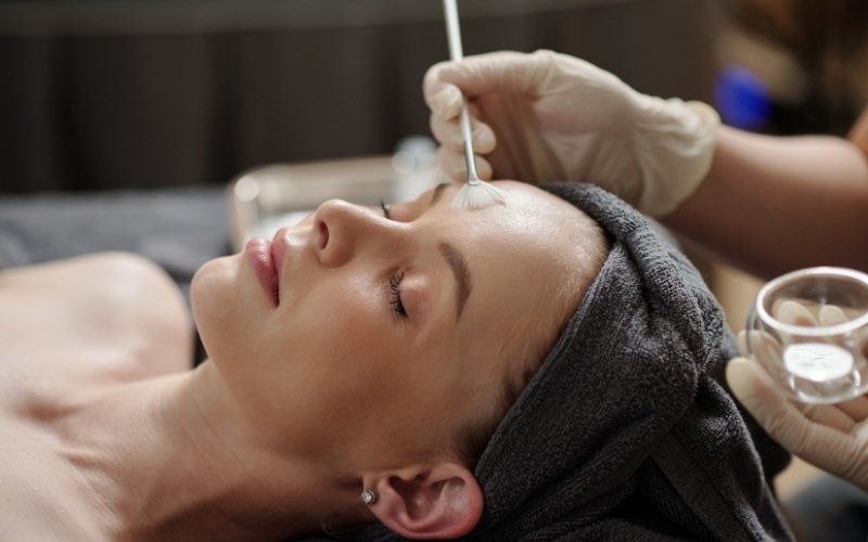 chemical peel during