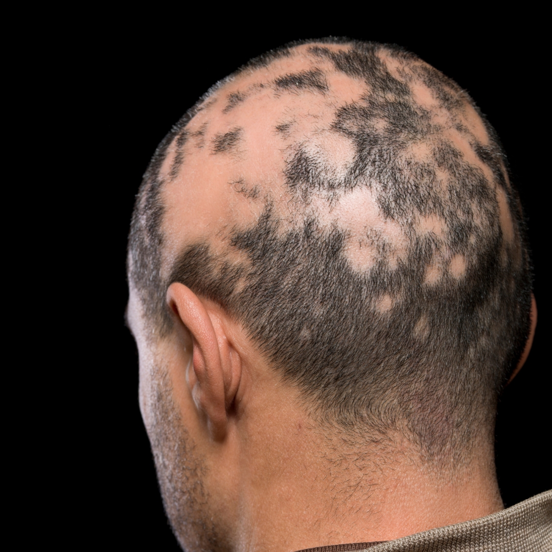 Androgenetic Alopecia