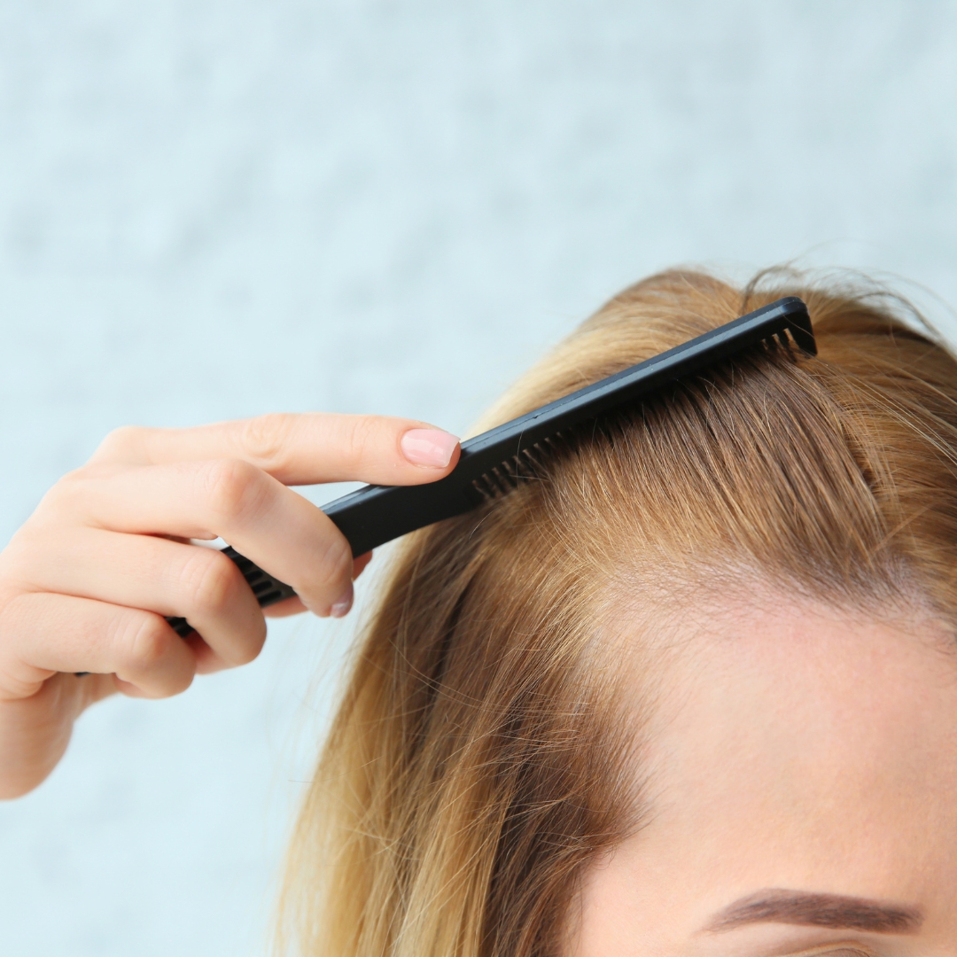 Female Hairloss Pattern