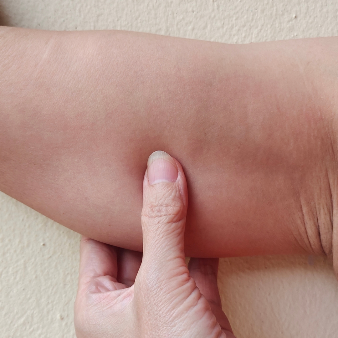 Laser hair removal arms and underarms