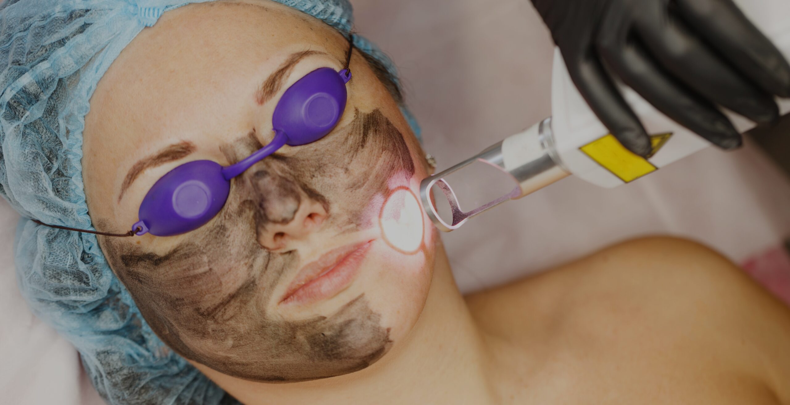 pico laser treatment in bangalore