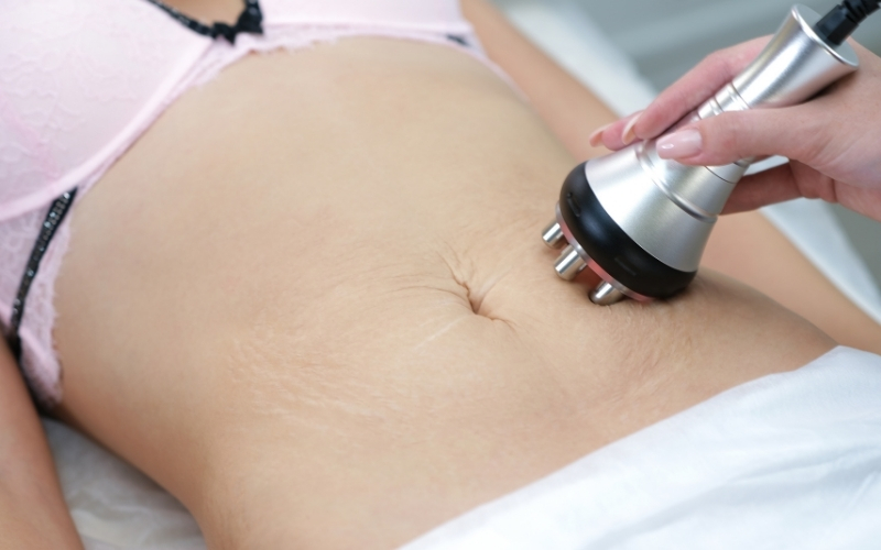 Ultrasound skin tightening during