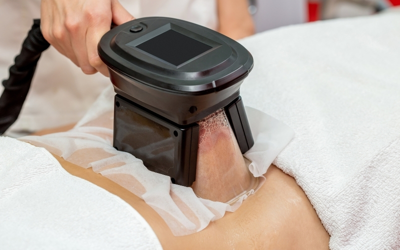 Cryolipolysis for Skin Tightening