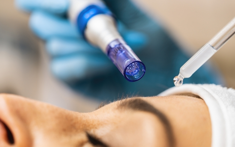 microneedling during