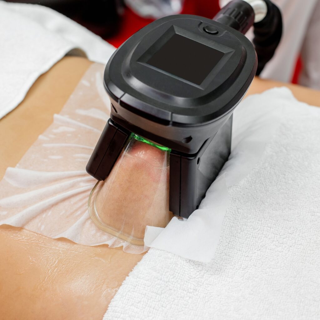 Cryolipolysis treatment in kothanur