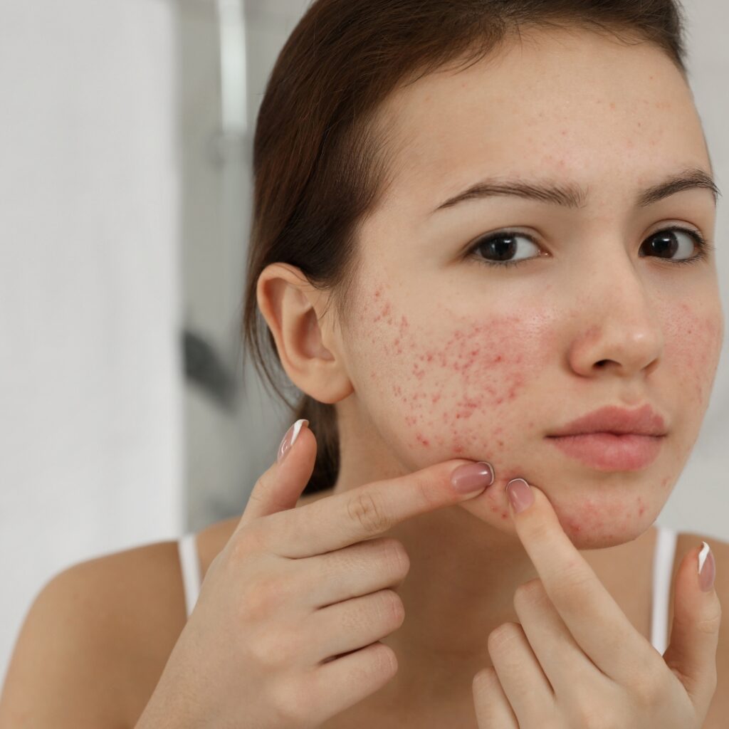 Acne Scar Treatment in Kothanur