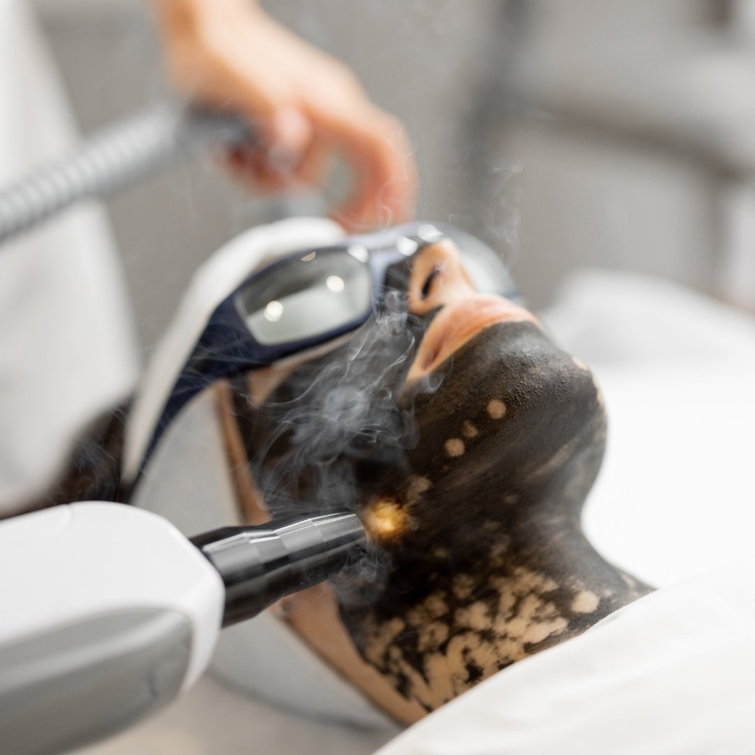 Carbon Laser Peel in Hennur