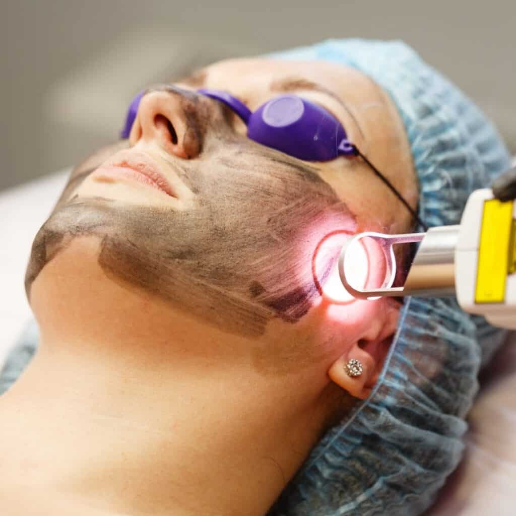 Woman receiving Pico laser facial treatment for skin rejuvenation in a clinic.