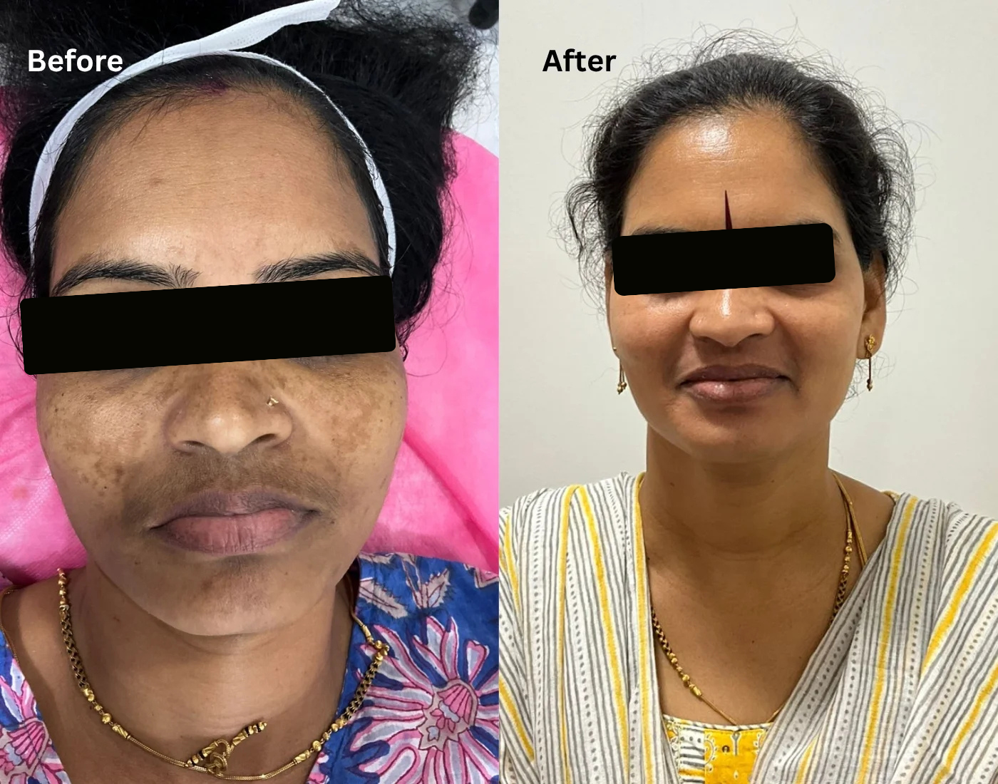 best pigmentation treatment in bangalore