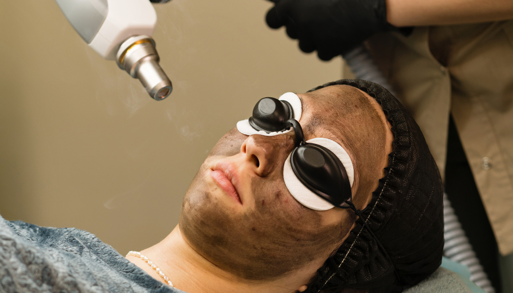 Carbon Laser Peel