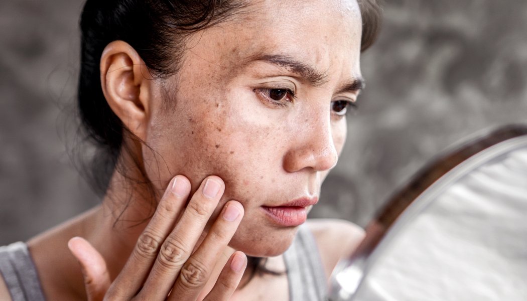 Pigmentation & Melasma