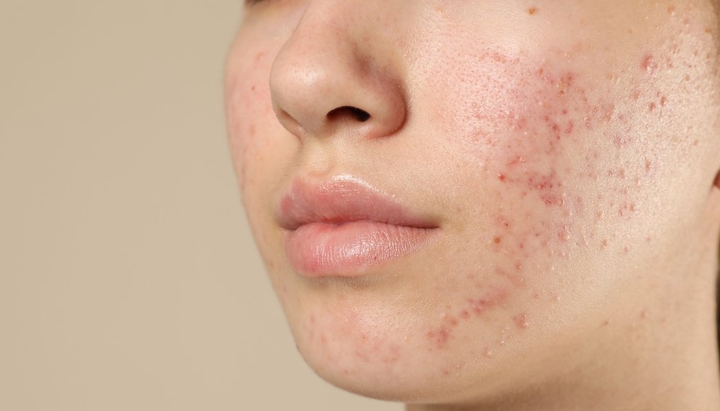 Acne & Acne Scars