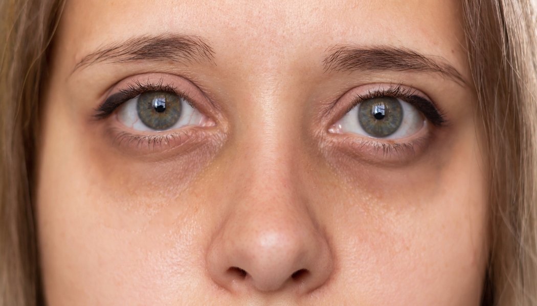 Dark Circles Treatment