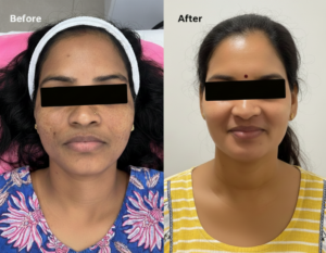 Best Pigmentation Clinic Near Me in Bengaluru | Aesthanic