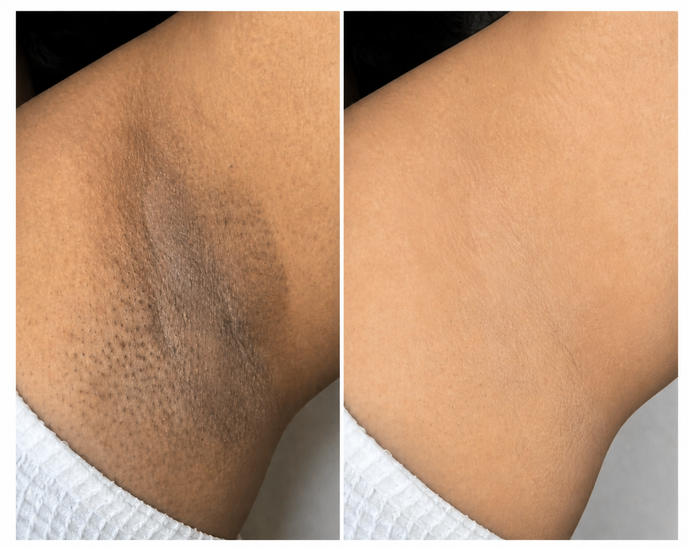 Underarm Before After