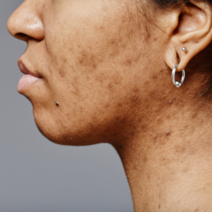 How to Get Rid of Dark Spots in Bengaluru - Expert Guide