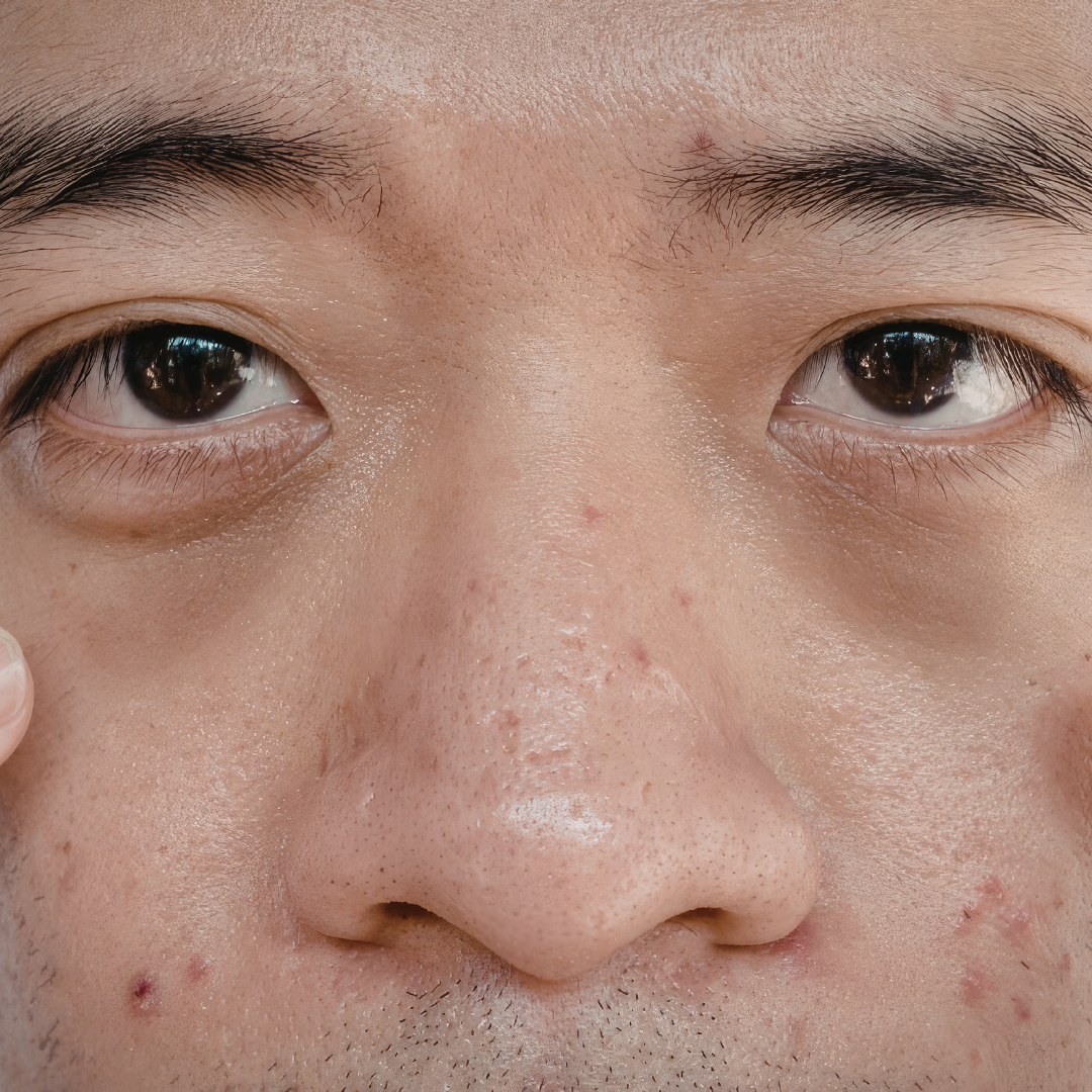 Professional Treatment Options for Dark Spot Removal